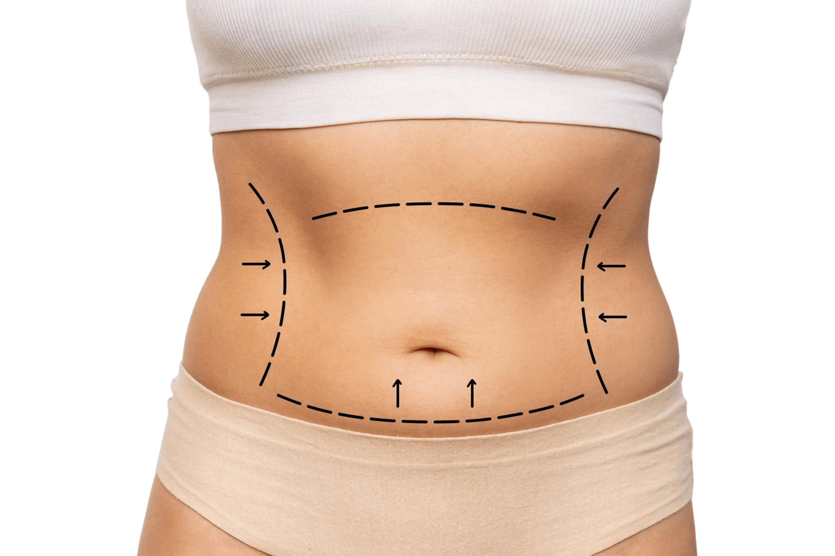 Abdominoplasty